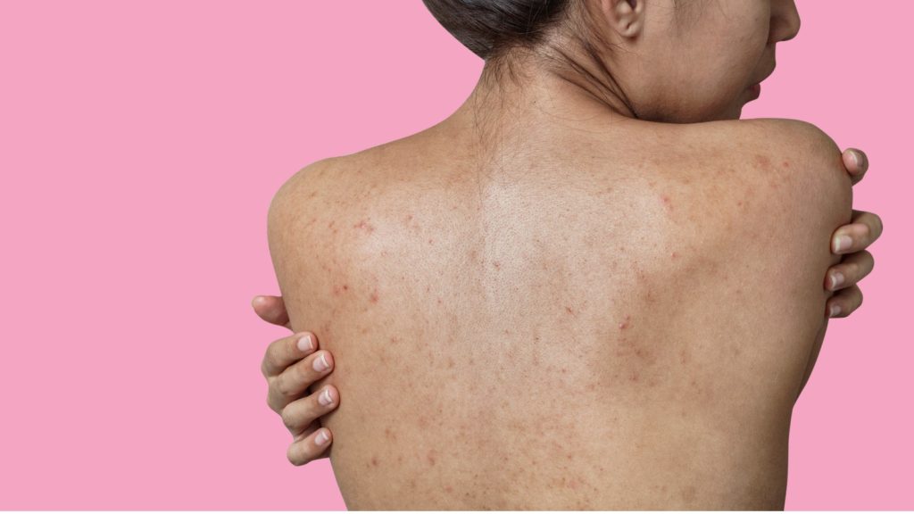 10 Practical Tips for Managing Body Acne