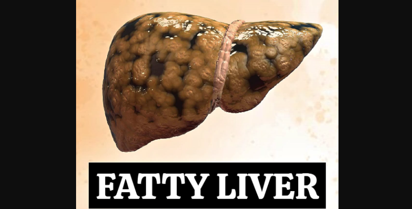 Early Warning Signs of Fatty Liver Disease and Steps That May Help Improve Liver Health